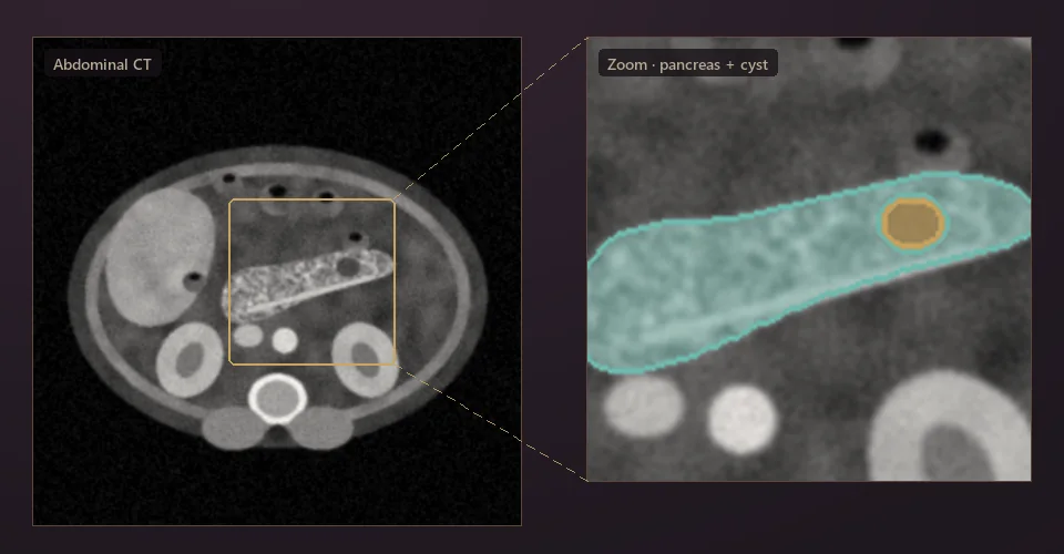 Illustration: abdominal CT with a zoomed view of the pancreas in teal and a small cyst in gold.