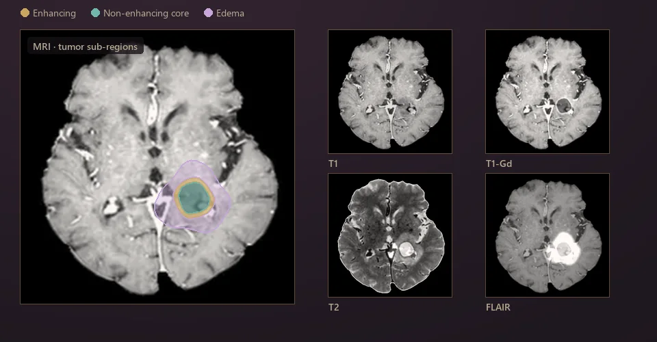 Illustration: brain MRI with tumor sub-regions (enhancing, core, edema) and four MRI sequences: T1, T1-Gd, T2 and FLAIR.