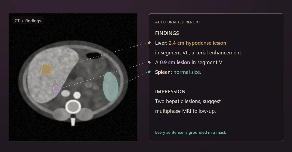 Illustration: CT slice with findings linked by dashed lines to sentences in an automatically drafted radiology report.