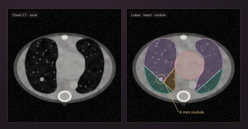 Illustration: axial chest CT, raw and with lung lobes, heart and a small nodule highlighted.