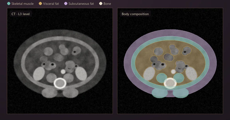 Illustration: CT slice at the L3 vertebra with skeletal muscle, visceral fat, subcutaneous fat and bone segmented.