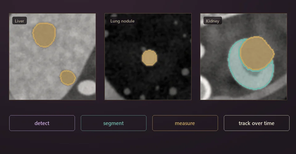 Illustration: zoomed tumors in the liver, lung and kidney, with the steps detect, segment, measure and track over time.